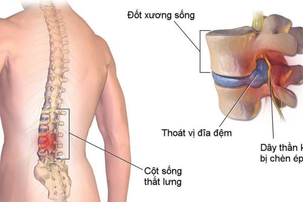 tim-hieu-thoat-vi-dia-dem-la-gi.jpg