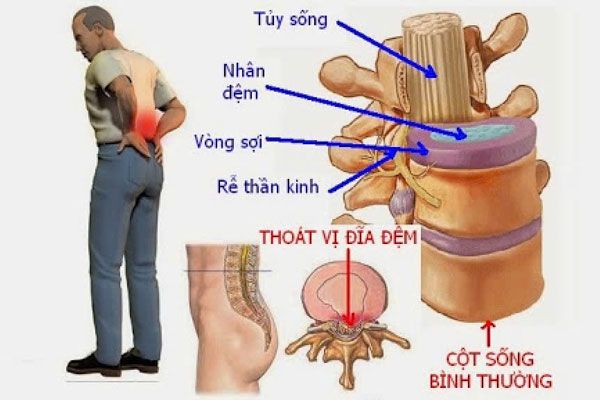 trieu-chung-thoat-vi-dia-dem-hien-nay-duoc-de-cap-den.jpg