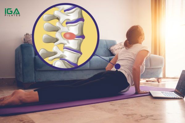 Lợi ích của vật lý trị liệu tại nhà bằng Pilates cho thoát vị đĩa đệm